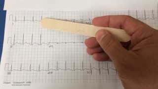 pericarditis on EKG [upl. by Arriat]