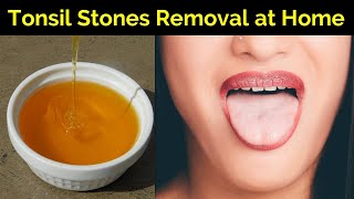 How to Cure Tonsillitis Permanently  Tonsil Stones Removal at Home  Tonsils Home Remedy [upl. by Igor823]