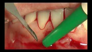 10 Bilaminar technique on single incisor in the lower jaw [upl. by Peltier]