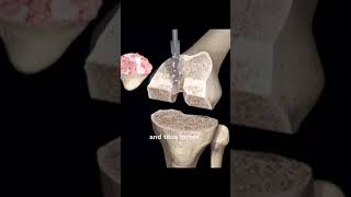 Total knee ArthroplastyTKAis a surgical procedure designed to replace the entire knee joint [upl. by Amek]