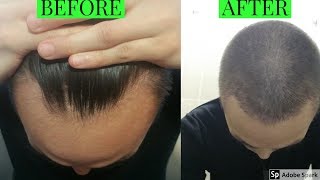 FINASTERIDE PROPECIA ONE YEAR UPDATE [upl. by Einhpad]