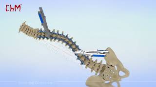 CHARSPINE2 VD  Vertebral Derotation [upl. by Summer]