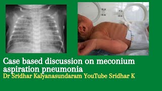 Meconium aspiration pneumonia Neonatal MAS Dr Sridhar K [upl. by Roanna]