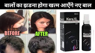 Kera XL New hair growth serum review बालों को झड़ने से रोक कर नए बाल उगाने वाला serum [upl. by Wilsey]