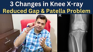 Knee x ray Knee Osteoarthritis Gap Reduced Chondromalacia patella Knee Joint Degeneration [upl. by Sheline]