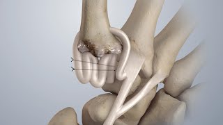 Osteoarthritis of the Thumb Surgical Treatment LRTI [upl. by Anirtap]