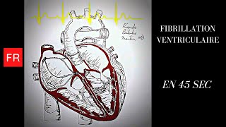 Arythmies animation cardiaque et ECG  Fibrillation Ventriculaire Shorts [upl. by Bihas]