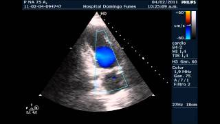 Insuficiencia Coronaria y Miocardiopatia Hipertrofica Septal Primariawmv [upl. by Barrus]