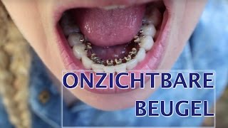 Onzichtbare beugel strakker zetten  FURROWNL [upl. by Durston]