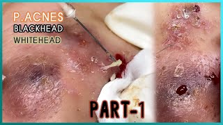 Big Cystic Acne Blackheads Extraction Blackheads amp Milia Whiteheads Removal Pimple Popping [upl. by Tildie]