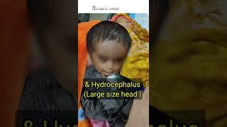 Baby with Talipes Equinoverus Hydrocephalus neonate baby [upl. by Irab]