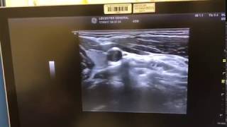 Cervical Sympathetic Chain Stellate Ganglion Block using Ultrasound [upl. by Christoph63]