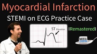 Myocardial Infarction  STEMI on ECG  Practice EKG [upl. by Quinby]