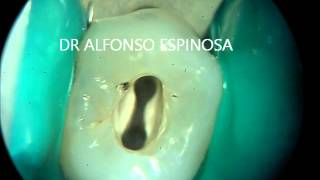 ENDODONCIA CON MICROSCOPIO [upl. by Tatiania761]