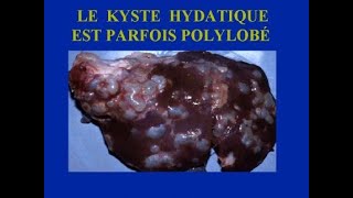 KYSTE HYDATIQUE DU FOIE [upl. by Lubeck308]