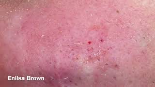 Blackheads Extractions Christian Part 2 [upl. by Aikkan]