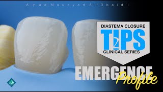 diastema closure technique tips [upl. by Ardin]