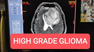 Imaging Tumors  High Grade Glioma MRI Brain with Contrast [upl. by Meingoldas92]