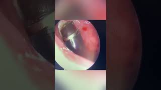 Removing Adenoids without bleeding or pain  Coblation Adenoidectomy [upl. by Otrebor]