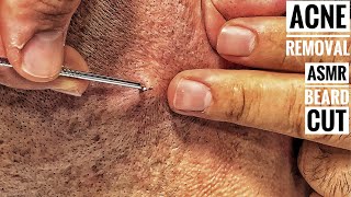 ASMR BEARD SHAVE And Subcutaneous acne removal • Barber Massage • Sleep Asmr [upl. by Akcebar450]