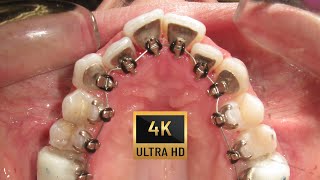 Golden LINGUAL BRACES in 4K  6 years After the treatment [upl. by Wye]