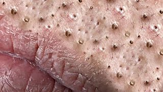 Big Cystic Acne Blackheads Extraction Blackheads amp Milia Whiteheads Removal Pimple Popping  1201 [upl. by Joscelin]