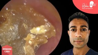 1352  Serial Cotton Swab User Attends with Severely Impacted Ear Wax [upl. by Akcirderf]