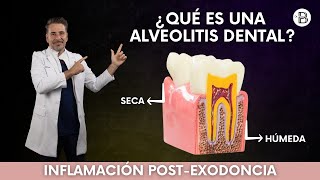 ALVEOLITIS dental Causas y tratamiento🦷 [upl. by Arit24]