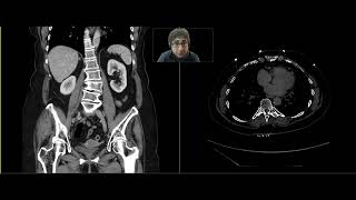 Urothelial neoplasm [upl. by Attenaej435]