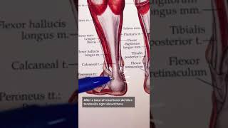 Insertional Achilles Tendonitis [upl. by Yebba]