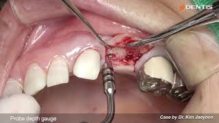 DENTIS Implant Upper premolars implant placement with SQ fixture [upl. by Fridlund590]