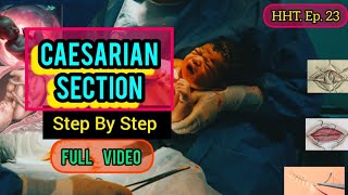 Caesarian Section Step By Step  obstetricsandgynecology surgerydayHHTep23healthedutainment [upl. by Sarson385]