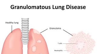 Granulomatous diseases of Lung Introduction [upl. by Katzir]