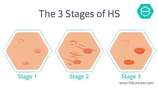 What is Hidradenitis Suppurativa [upl. by Huntlee]