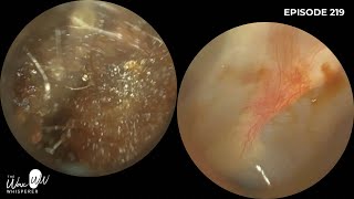 220  Difficult Ear Wax Removal in Narrow Ear with the WAXscope [upl. by Sigmund351]