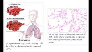 Emphysema  quotPink Pufferquot  Centriacinar amp Panacinar [upl. by Ranitta347]