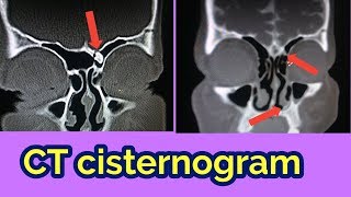 CT SCAN CISTERNOGRAM Part 12 [upl. by Eded]