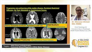 Dr Manzoor Ahmed l Adult Onset Leukodystrophy [upl. by Jansson]