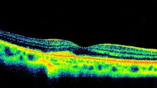 Choroidal Neovascularization [upl. by Lenrad560]