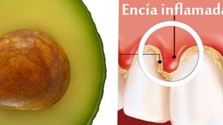 ✔ CURA PARA ENCIAS INFLAMADAS  Remedios Caseros para Aliviar Encias Inflamadas al INSTANTE [upl. by Aihsekan]