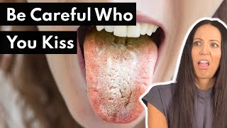 Can You Get A Yeast Infection In Your Mouth White Tongue Oral Thrush [upl. by Jerroll654]