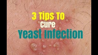 3 Tips To Cure Yeast Infection [upl. by Hgielar]