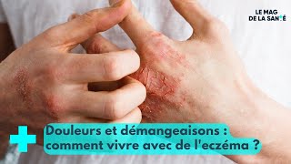 Eczéma  une maladie qui dérange et qui démange  Le Mag de la Santé [upl. by Bullard]