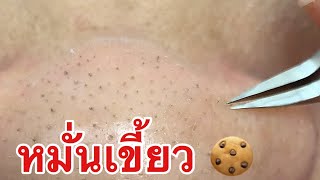 กดสิว blackheads filaments on nose remove with tweezers [upl. by Mandie]