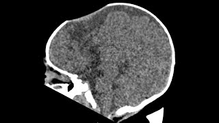 Sanken fontanelle  paediatric neuro case  CT findings [upl. by Goldsmith608]