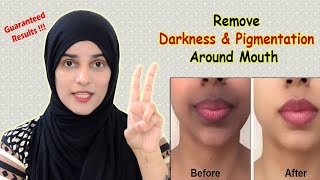 How to Remove Dark Upper Lips  Black patches Dark Spots Hyper pigmentation around Mouth [upl. by Nylatsirhc]