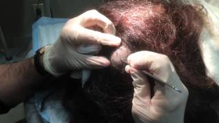 Pilar Cyst Removal on the Scalp [upl. by Lah]