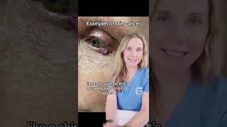 What to know about basal cell carcinoma [upl. by Patti]