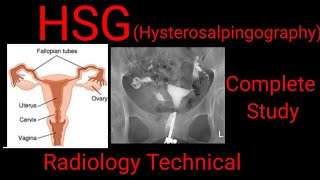 HSG  Hysterosalpingography Complete study Radiology technical  by BL Kumawat [upl. by Pavyer807]