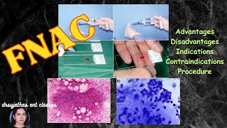 237Fine Needle Aspiration Biopsy  fine needle aspiration cytology fnac surgeryeducation fnac [upl. by Hoy]